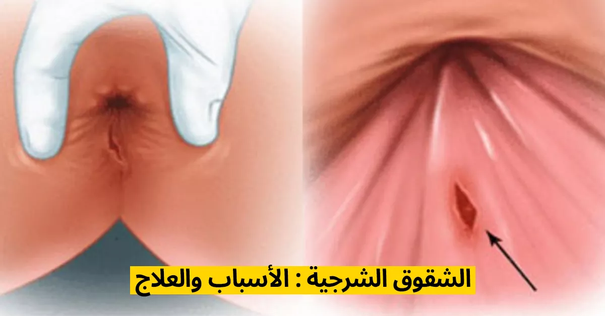 الشقوق الشرجية : الأسباب والعلاج